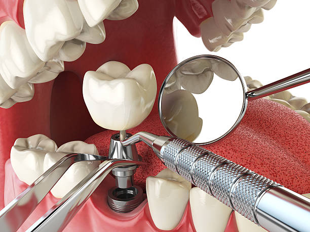 Best Emergency Root Canal Therapy in Union Park, FL